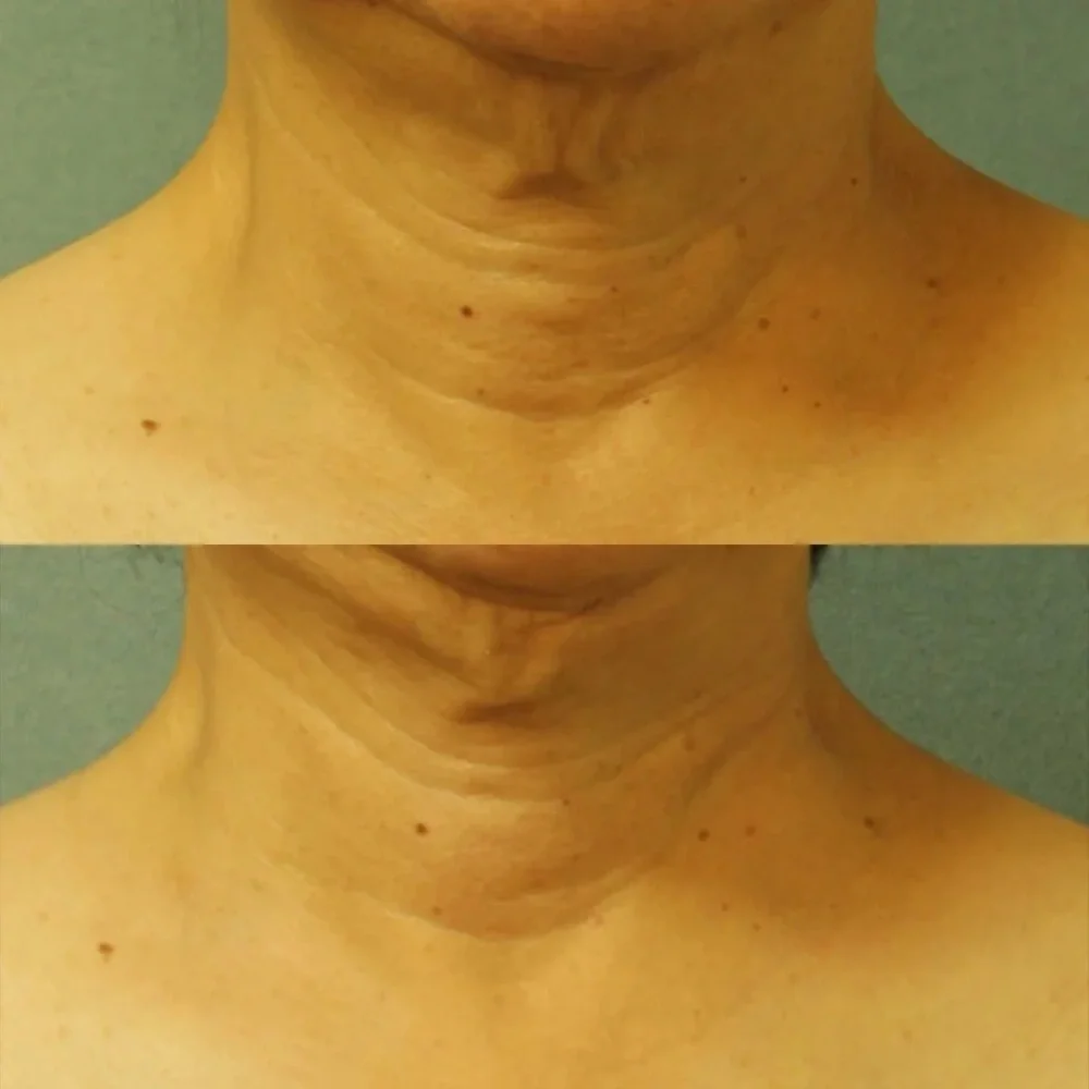 Periscope MD, Cold Plasma Plus+ Neck & Chest Broad Spectrum SPF 25, 1oz / 30ml